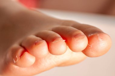 How To Remove Thick Dead Skin From Feet