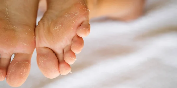 How To Get Rid Of Hard Skin On Feet
