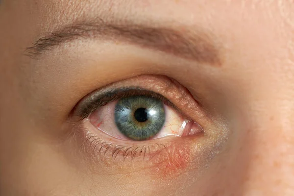 How Eyes Infection Is Damage Our SKin 